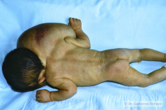 linfangio-hemangioma-higroma-quistico-cervical-der-transiluminacion-009
