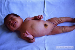 linfangio-hemangioma-higroma-quistico-cervical-izq-001