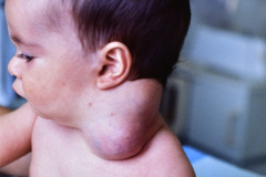 linfangioma-cervical-izq-1987-001