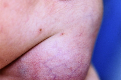 linfangioma-cervical-izq-1987-002