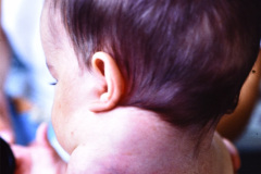 linfangioma-cervical-izq-1987-003