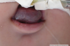 linfangioma-cervical-oclusivo-2009-001