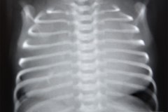 linfangioma-mediastinal-1990-000