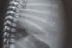 linfangioma-mediastinal-1990-001