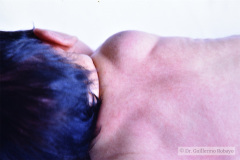 linfangioma-000