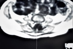 lipoma-lumbar-medula-anclada-hidrocefalia-con-derivacion-1991-000