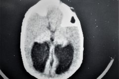 lipoma-lumbar-medula-anclada-hidrocefalia-con-derivacion-1991-001