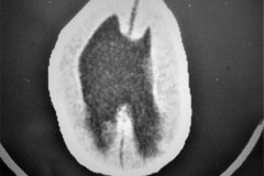 lipoma-lumbar-medula-anclada-hidrocefalia-con-derivacion-1991-002