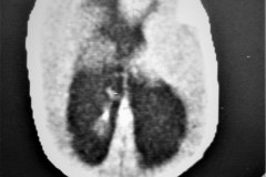 lipoma-lumbar-medula-anclada-hidrocefalia-con-derivacion-1991-003