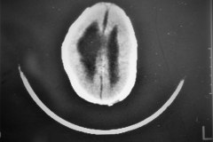 lipoma-lumbar-medula-anclada-hidrocefalia-con-derivacion-1991-004