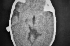 lipoma-lumbar-medula-anclada-hidrocefalia-con-derivacion-1991-005