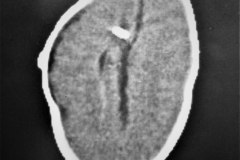 lipoma-lumbar-medula-anclada-hidrocefalia-con-derivacion-1991-006