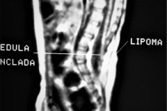 lipoma-lumbar-medula-anclada-hidrocefalia-con-derivacion-1991-007