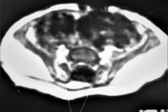 lipoma-lumbar-medula-anclada-hidrocefalia-con-derivacion-1991-008