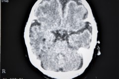 lisencefalia-cavum-septum-pellucidun-vergae-tac-rnm-1998-003