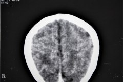 lisencefalia-cavum-septum-pellucidun-vergae-tac-rnm-1998-007