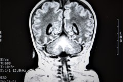 lisencefalia-cavum-septum-pellucidun-vergae-tac-rnm-1998-009