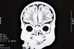 lisencefalia-cavum-septum-pellucidun-vergae-tac-rnm-1998-017