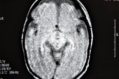 lisencefalia-cavum-septum-pellucidun-vergae-tac-rnm-1998-022