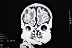 lisencefalia-cavum-septum-pellucidun-vergae-tac-rnm-1998-024