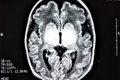 lisencefalia-cavum-septum-pellucidun-vergae-tac-rnm-1998-026