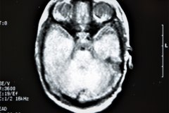 lisencefalia-cavum-septum-pellucidun-vergae-tac-rnm-1998-029