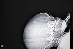 lisencefalia-cavum-septum-pellucidun-vergae-tac-rnm-1998-030
