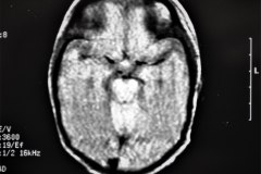 lisencefalia-cavum-septum-pellucidun-vergae-tac-rnm-1998-031