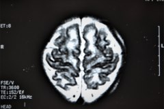 lisencefalia-cavum-septum-pellucidun-vergae-tac-rnm-1998-033