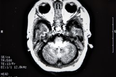 lisencefalia-cavum-septum-pellucidun-vergae-tac-rnm-1998-036