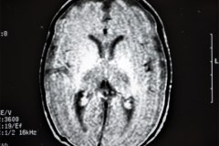 lisencefalia-cavum-septum-pellucidun-vergae-tac-rnm-1998-037