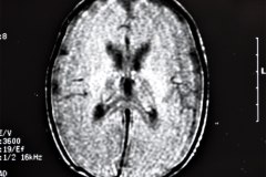 lisencefalia-cavum-septum-pellucidun-vergae-tac-rnm-1998-038