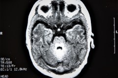 lisencefalia-cavum-septum-pellucidun-vergae-tac-rnm-1998-040