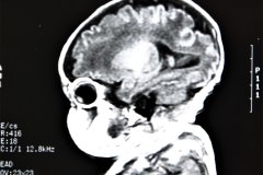 lisencefalia-cavum-septum-pellucidun-vergae-tac-rnm-1998-042