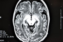 lisencefalia-cavum-septum-pellucidun-vergae-tac-rnm-1998-043