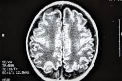 lisencefalia-cavum-septum-pellucidun-vergae-tac-rnm-1998-045