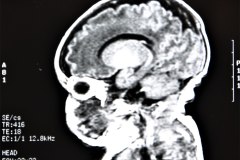 lisencefalia-cavum-septum-pellucidun-vergae-tac-rnm-1998-047