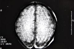 lisencefalia-cavum-septum-pellucidun-vergae-tac-rnm-1998-048