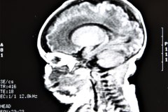 lisencefalia-cavum-septum-pellucidun-vergae-tac-rnm-1998-049
