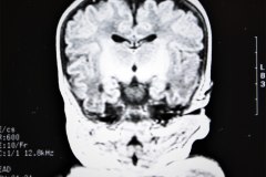 lisencefalia-cavum-septum-pellucidun-vergae-tac-rnm-1998-050