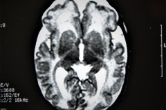 lisencefalia-cavum-septum-pellucidun-vergae-tac-rnm-1998-051