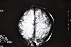 lisencefalia-cavum-septum-pellucidun-vergae-tac-rnm-1998-053