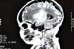 lisencefalia-cavum-septum-pellucidun-vergae-tac-rnm-1998-055