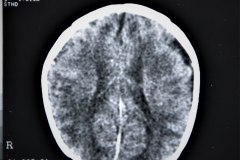 lisencefalia-cavum-septum-pellucidun-vergae-tac-rnm-1998-057