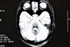 lisencefalia-cavum-septum-pellucidun-vergae-tac-rnm-1998-058