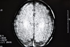 lisencefalia-cavum-septum-pellucidun-vergae-tac-rnm-1998-059
