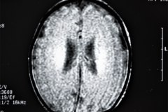 lisencefalia-cavum-septum-pellucidun-vergae-tac-rnm-1998-060