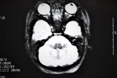 lisencefalia-cavum-septum-pellucidun-vergae-tac-rnm-1998-061