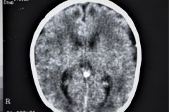 lisencefalia-cavum-septum-pellucidun-vergae-tac-rnm-1998-063