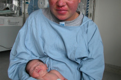 lupus-eritematoso-congenito-hijo-y-madre-2006-001